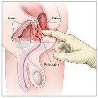 Prostatamassage